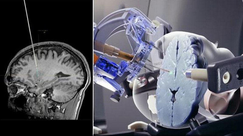 מוצר של חברת ClearPoint Neuro, Inc. | 👁️GURU.Markets👁️ מוצר עיקרי של ClearPoint Neuro, Inc.
