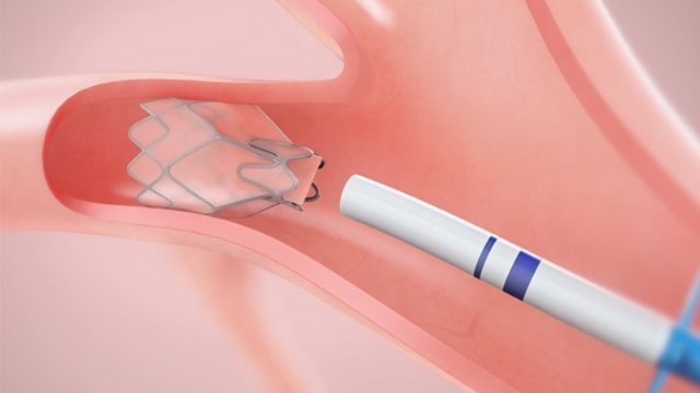 Pulmonx - conto produk | 👁️GURU.Markets👁️ Produk merek Pulmonx
